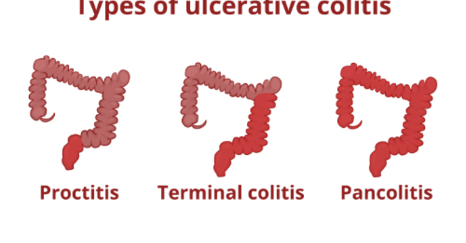 What Is Ulcerative Colitis? image